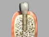 What Is A Dental Implant?