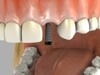 Single Tooth Implant
