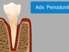 Advanced Periodontitis